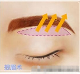 欧洲之星fotona4d能提眉吗?美白淡斑\淡化皱纹等都是作用!提眉有哪几种方法?