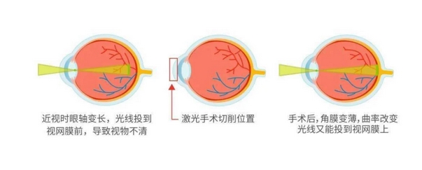 准分子激光手术后遗症有哪些?医生亲身告诉你!ta改良近视的真相~