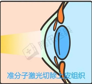 准分子激光手术后遗症有哪些?医生亲身告诉你!ta改良近视的真相~