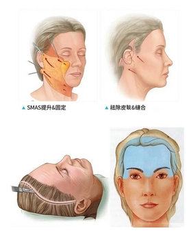 北京华韩拉皮手术价目表公开！看技术与口碑实力并存的医生有哪些？让 面部保持年轻化~