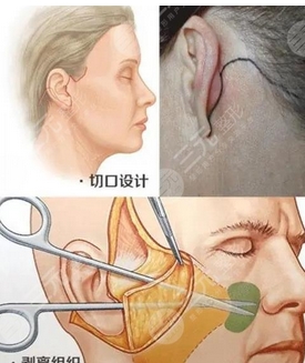 北京华韩高亚东大拉皮怎么样?医生拉皮手术技术高口碑好!肌肤洁白不留疤~