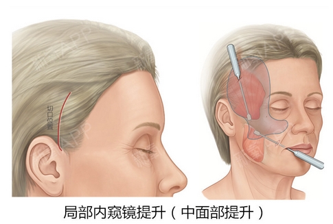 北京华韩高亚东大拉皮怎么样?医生拉皮手术技术高口碑好!肌肤洁白不留疤~