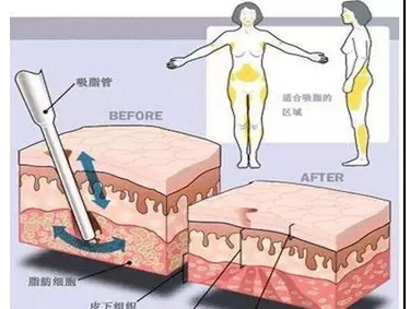 做抽脂要多少钱？哪些因素影响抽脂的价格？面诊前必看哦~