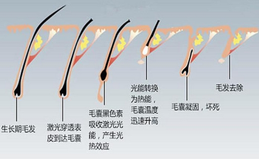 广东省第二人民医院可以做激光脱毛吗？光滑细腻的美肤，夏日标配！