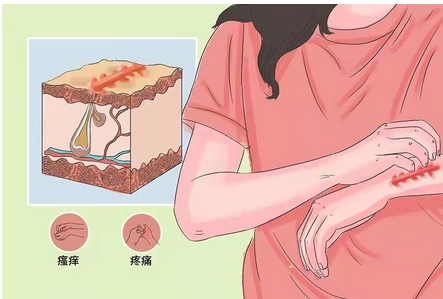 如何消除疤痕？三种医美方法分享，让你修复痕迹重拾美丽！