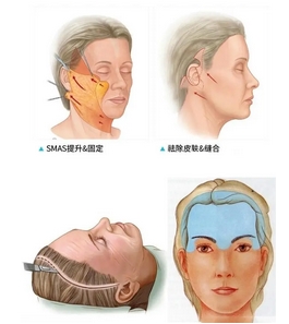北京王驰拉皮手术怎么样？坐诊医院正规吗？手术案例揭秘！