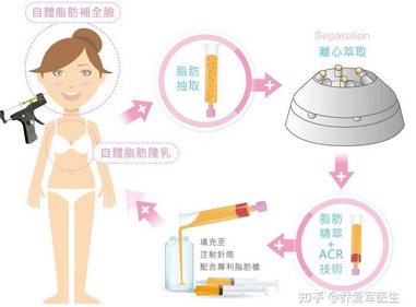 腹部吸脂手术价格怎么样？手术原理-消肿保姆级攻略get！好评满满~