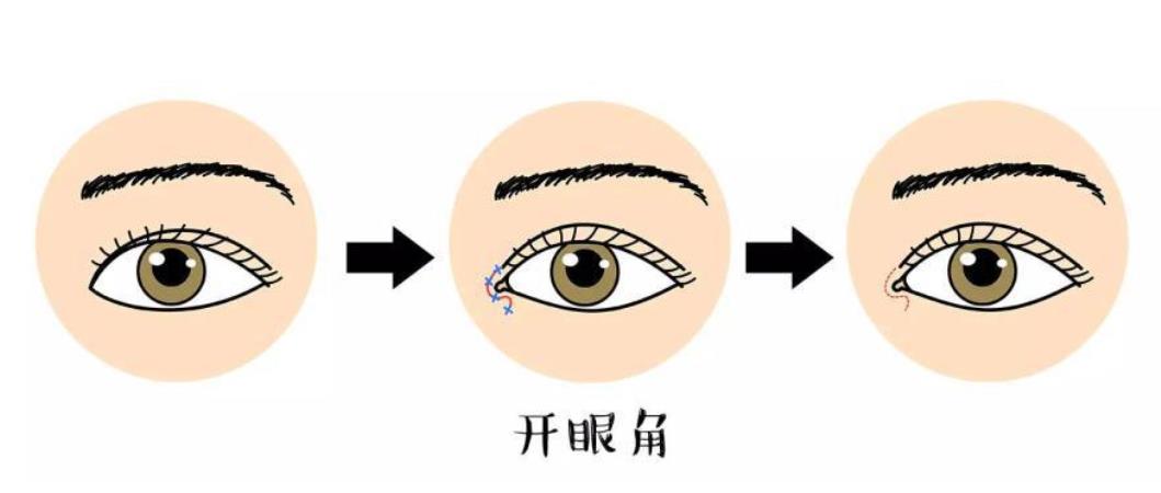 张冰洁眼角修复怎么样？技术风格&近期案例:动漫电眼~