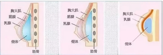 硅胶隆胸可以永久不取出来吗？原理是什么呢？术后这些事项也需要注意~