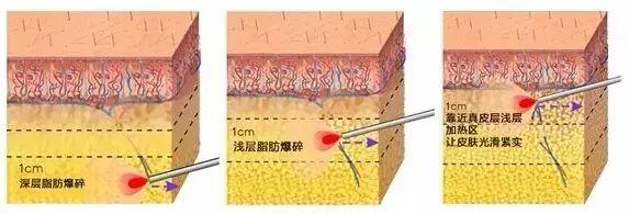 王春虎大小腿吸脂怎么样？医生简介-吸脂技术水平-近期案例