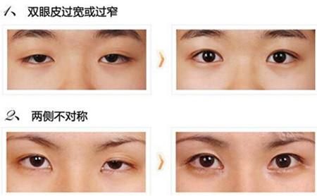 北京协和医院黄久佐做双眼皮怎么样？医生点评-价格-案例图