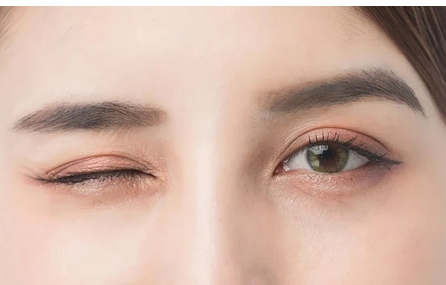 深圳艺星黄海峡双眼皮怎么样？坐诊医院简介及擅长项目！打造自然灵动大眼睛~