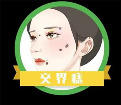 周怡雯做皮肤色素痣怎么样？祛痣案例分享！