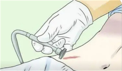 王佳琦做面颈部瘢痕修复怎么样？医生真实技术怎么样？内附疤痕修复案例！