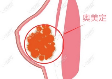 奥美定后遗症在多久后发生？术前术后应该注意什么？取出刻不容缓~