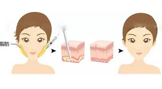 深圳贝加美万芸做脂肪填充怎样？医生审美风格怎么样？鼻梁弧度立体流畅~