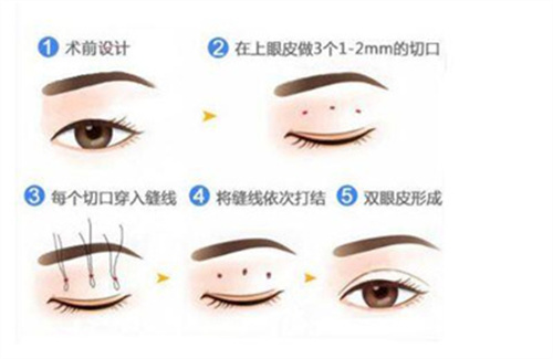 宋楠医生双眼皮案例分享，医生个人简介，看技术如何？