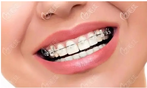 深圳阳光牙齿矫正价格怎么样?真实案例测评介绍!反手就是一个收藏~
