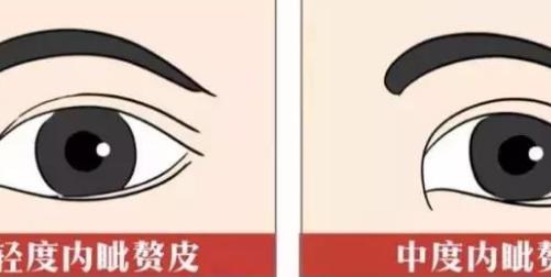 宋楠医生双眼皮案例分享，医生简介，手术价格参考！