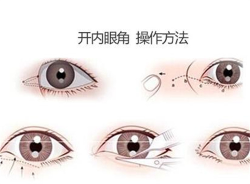 申霄双眼皮案例分享，个人技术公布，看案例前后对比图