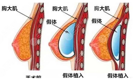 广州中科美整形医院隆胸价格如何?医院实力有保障,隆胸体验案例一览!