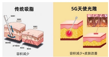 水动力吸脂和5G光雕哪个果好？吸脂对身体有害吗？实现性感曲线身材~