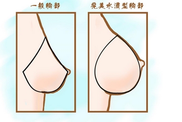 做胸部整形手术痛吗？术前术后分别注意什么？|乳晕也包含在内！