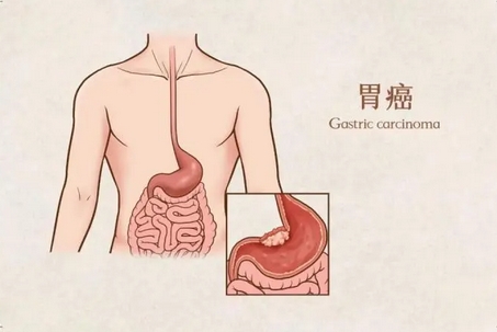 哪些不良习惯会导致胃癌的发生？除了暴饮暴食还有哪些因素影响呢？一并介绍~