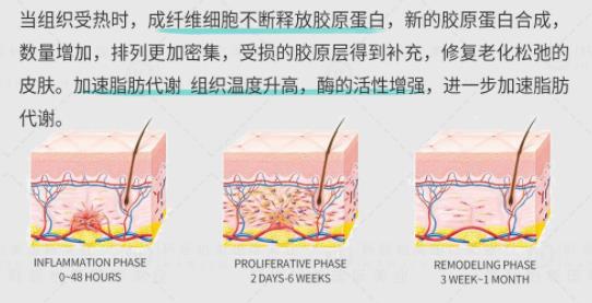 聚拉提和超声炮哪个效果好？优势、注意事项盘点！