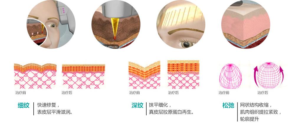 正规医院光子嫩肤价格是多少？收费区间&优点、缺点大盘点！