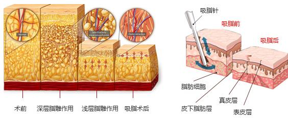 陈子翔做精细化吸脂塑形怎么样？医生简介-技术特色-案例-价格