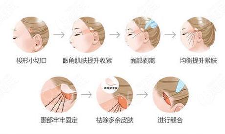 面部拉皮有几种方法？从层次和类型上来看有这几种！