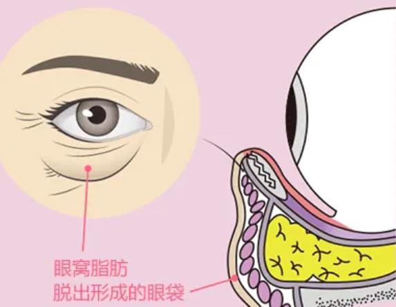 李圣利技术怎么样？坐诊医院基本资料介绍！眼袋去除效果图曝光！
