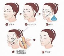 拉皮手术恢复期多久自然？肿胀、僵硬一般在7天左右改良！