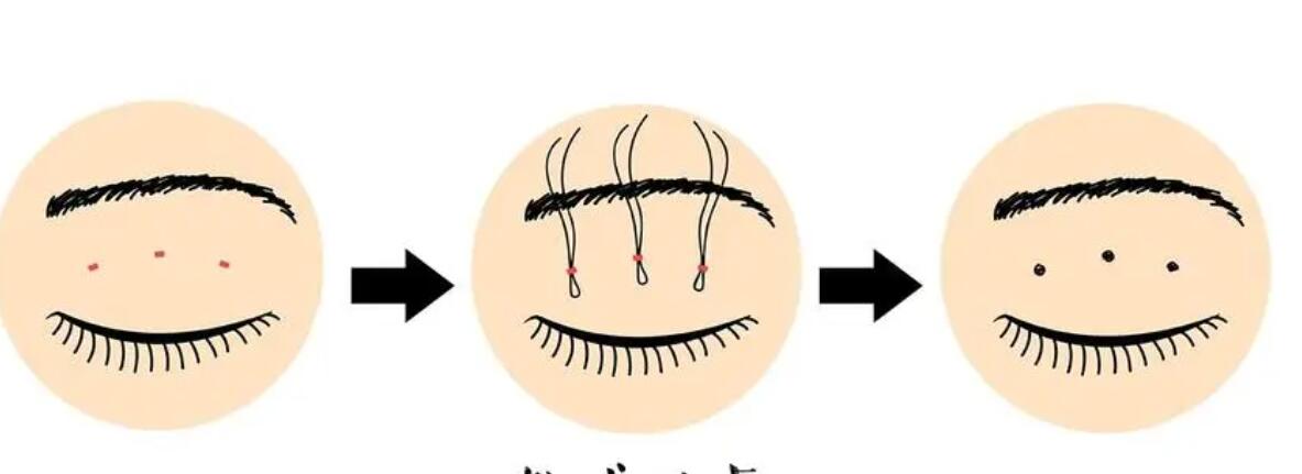 顾钏双眼皮修复技术靠谱吗？真人案例|医生简介|价格表