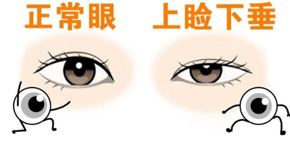 上睑下垂矫正术调节方法，方法和注意事项！