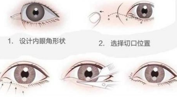 开内眼角有后遗症吗，是暂时性的吗！