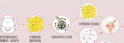 斯楼斌脂肪填充价格多少？真人做面部填充案例介绍！附价格表