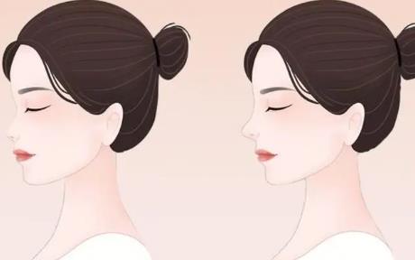 杜丽平的综合鼻整形怎么样？真人做隆鼻案例分享！价格表