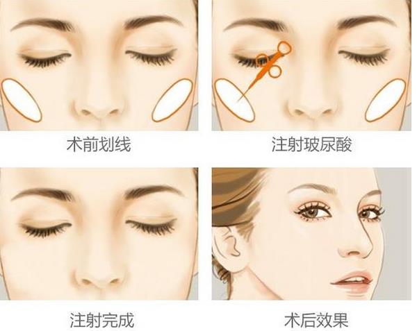 苹果肌断层有啥办法解决？断层的原因有这两点！