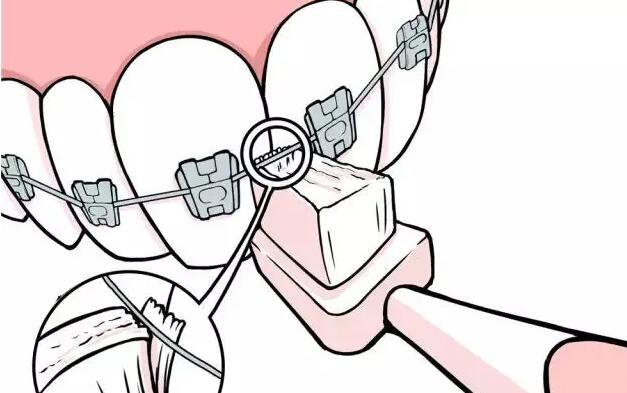北京大兴兴业口腔医院怎么样？真人正畸案例分享：公布恢复过程！