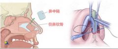 蒜头鼻整形图片对比|网友自身案例:2个月鼻型立挺有气质！