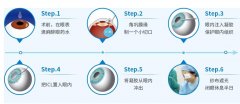 人工晶体植入多少钱？能用多少年？有危害吗？摘镜指南~