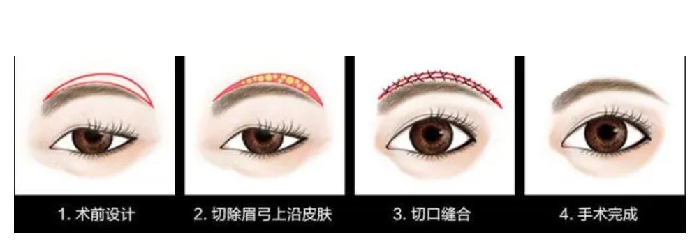 武汉乐美医疗美容门诊部怎么样？资料简介_玻尿酸丰眉骨案例