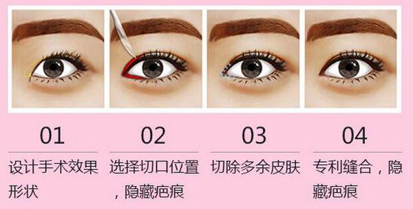 大连高岚医疗美容门诊部怎么样_实力口碑_开眼角案例图