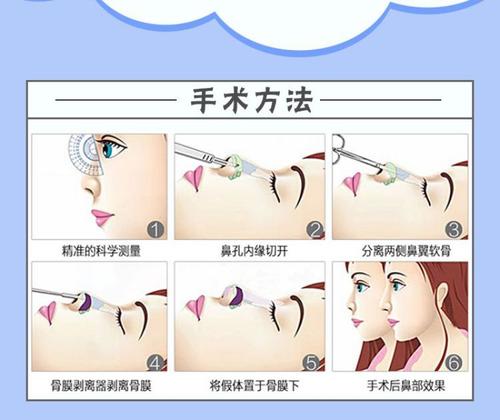 巫文云技术到底好不好？医生简介_手术价位_假体隆鼻案例