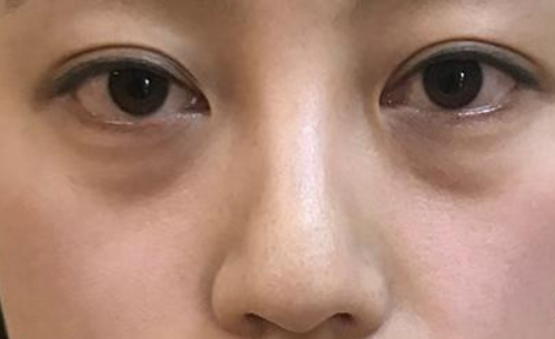 北京超声法去眼袋哪里好，附案例介绍！