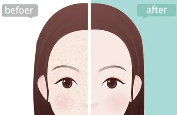 激光能治黄褐斑吗，手术前后需要注意什么！