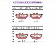 冷光美白牙齿可以白到啥程度？可以维持多久？有伤害吗？