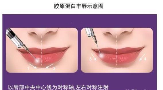 注射丰唇什么材料好？玻尿酸、胶原蛋白等介绍，气质唇型get指南！